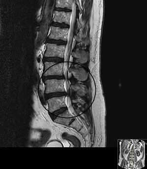 MRT der Lendenwirbelsäule mit Bandscheibenvorfall