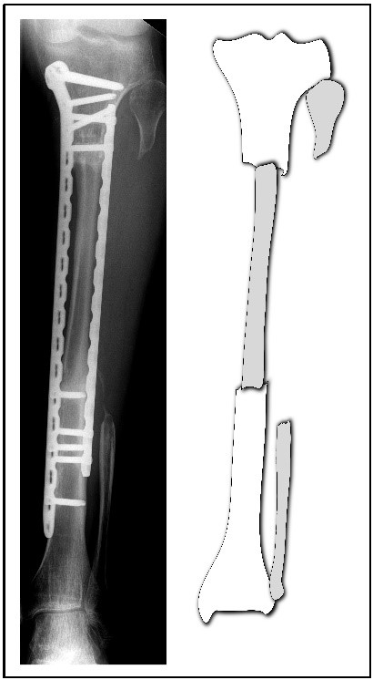 Knochenrekonstruktion
