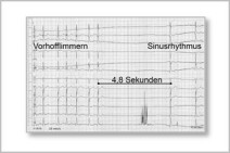 Pause im EKG